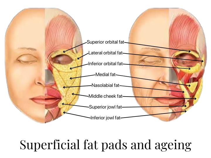 fat volume loss melbourne dermal filler
